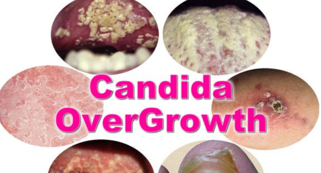 Understanding Candida Overgrowth: